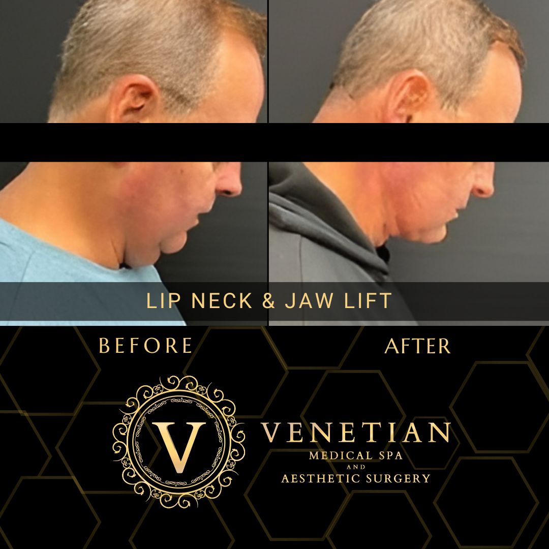 Venetian Medical Spa Lip, Neck, and Jaw Lift Patient