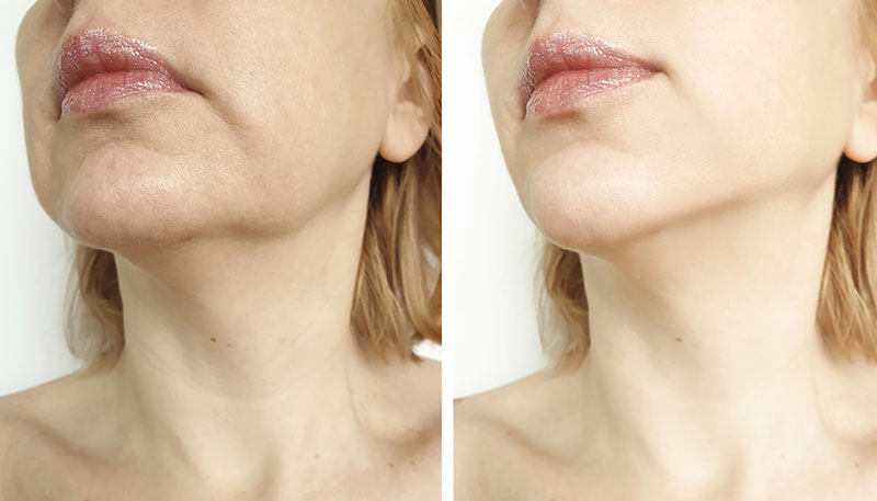 Neck and Jaw Lift Before and After MyEllevate procedure