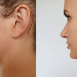 Neck and Jaw Lift Before and After MyEllevate procedure